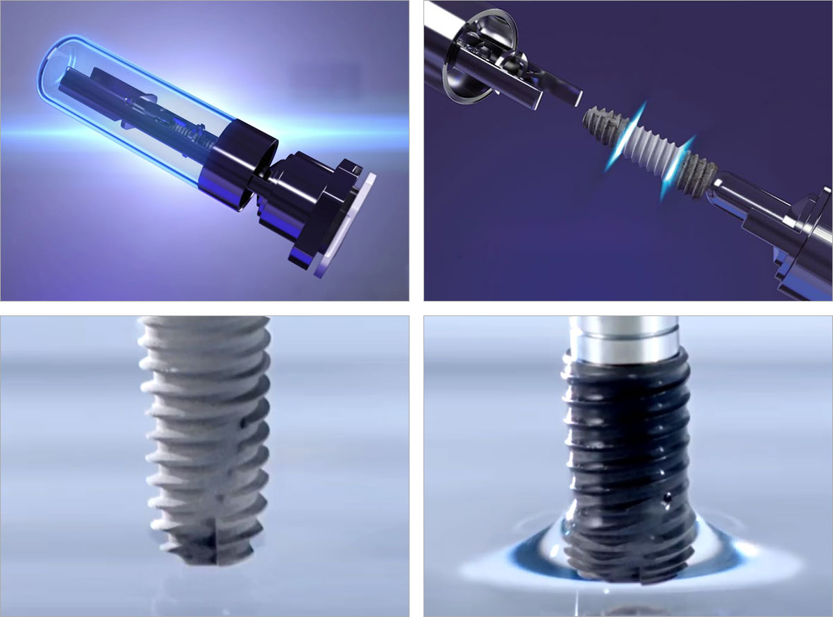 광촉매 UV 임플란트의 우수성