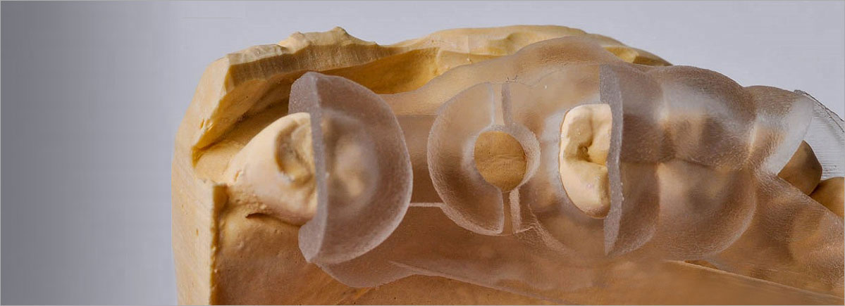 가이드 임플란트