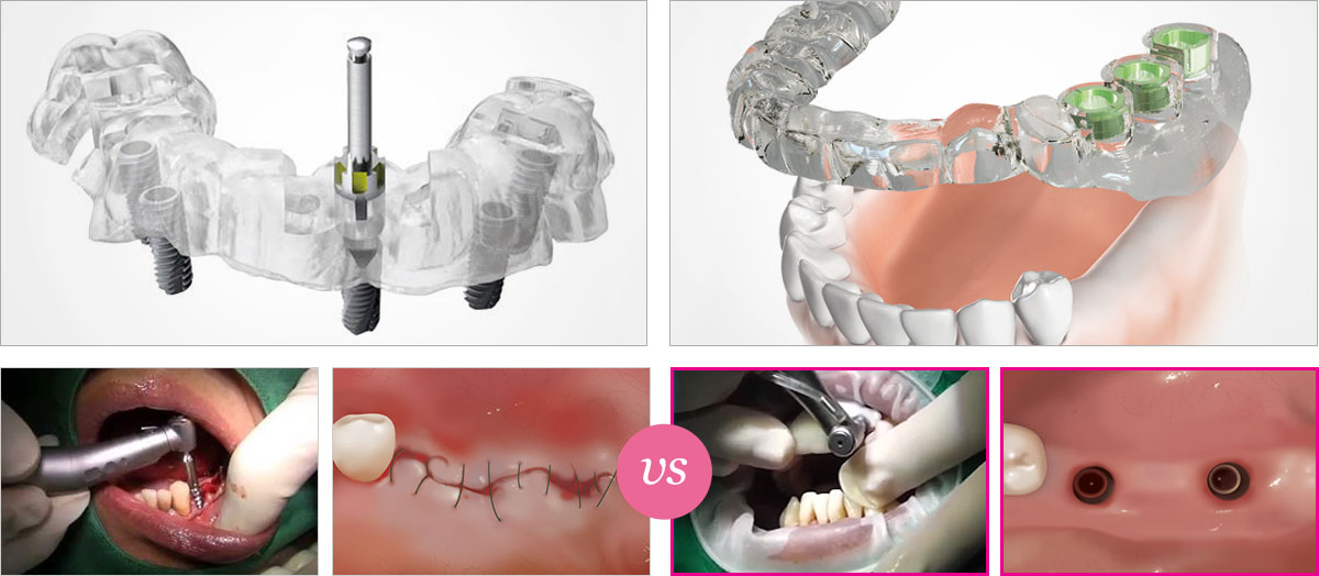 최소절개 가이드 임플란트