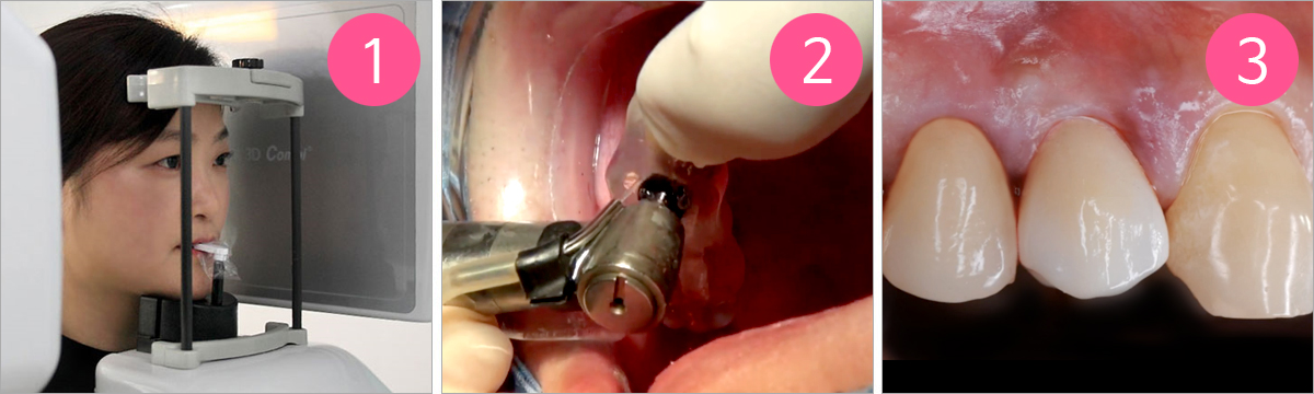 최소 내원 임플란트