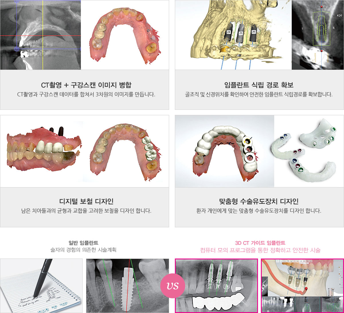 네비게이션 임플란트